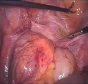 kidney laparoscopic surgery 