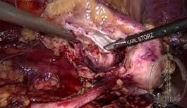 laparoscopic nefrectomy 