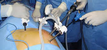 kidney laparoscopic surgery
