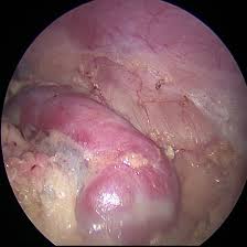 kidney laparoscopic surgery