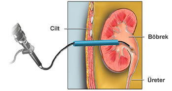 PCNL